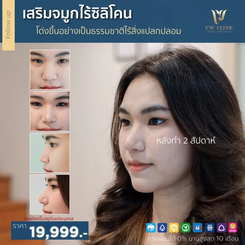 เสริมจมูกไร้ซิลิโคน