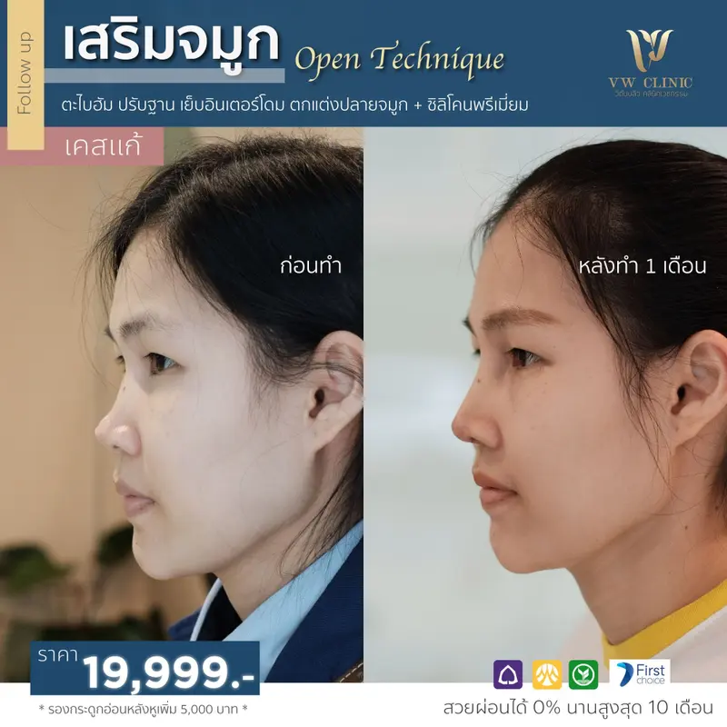 เสริมจมูก 