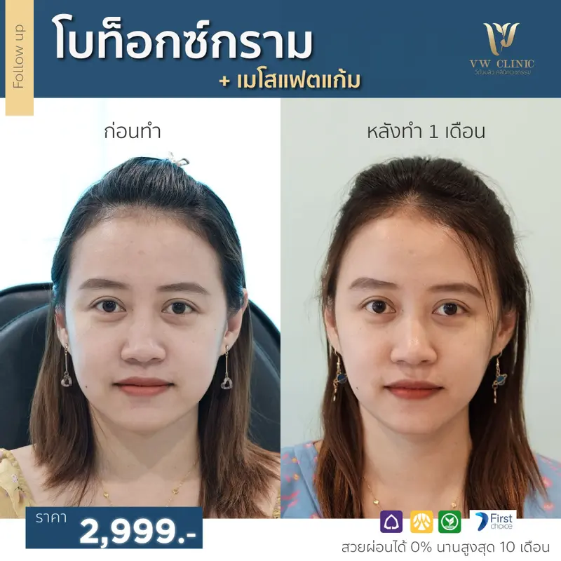 Botox กราม