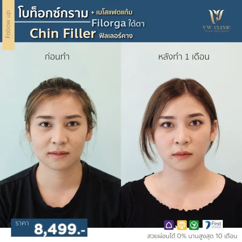 Filler + Botox + Fat