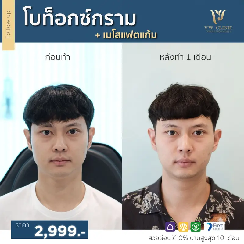 Botox กราม