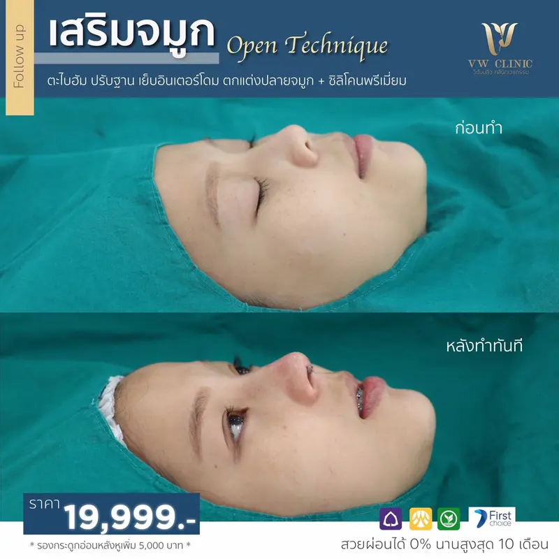 เสริมจมูก