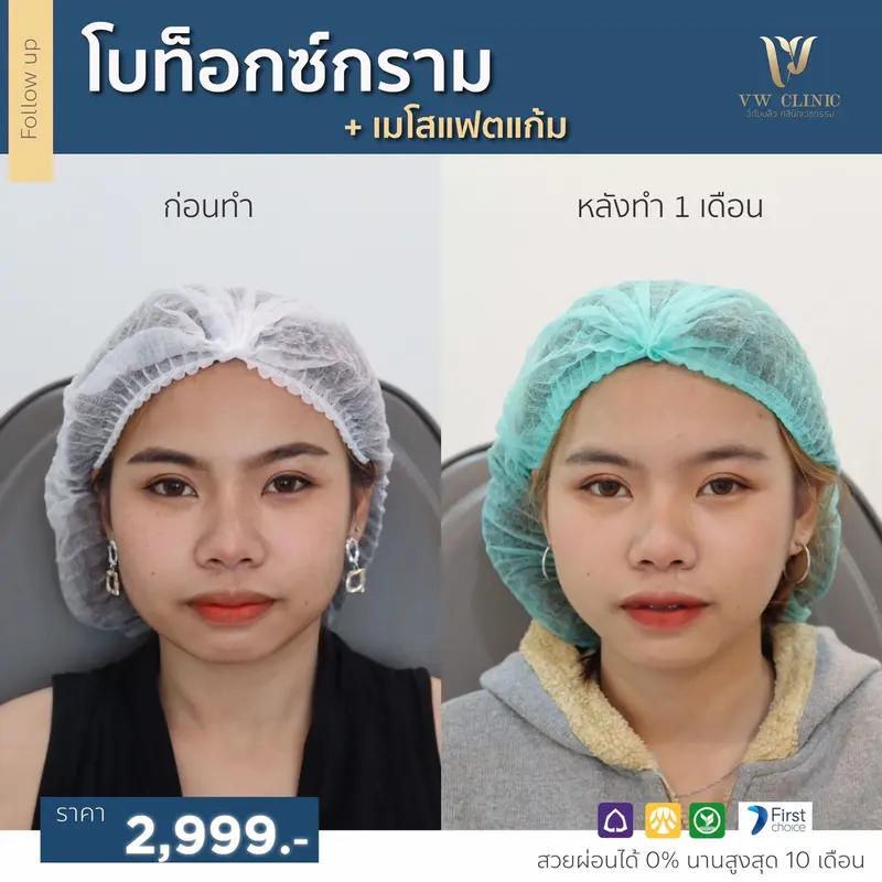 Botox กราม + Fat แก้ม