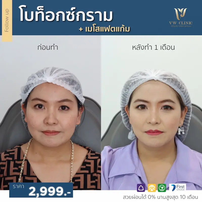 Botox กราม + Fat แก้ม