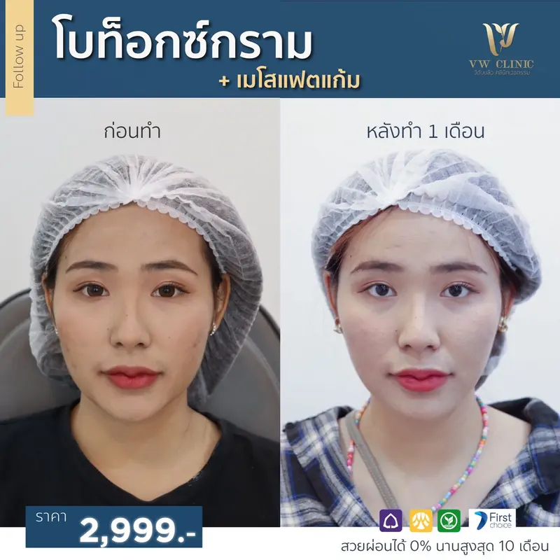 Botox กราม + Fat แก้ม