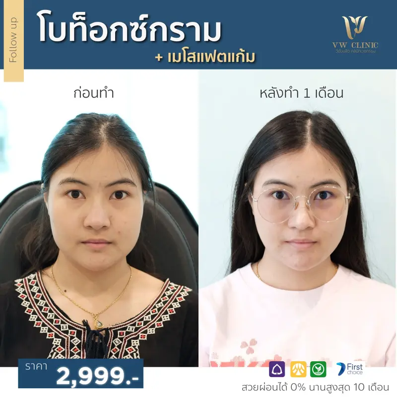 Botox กราม + Fat แก้ม