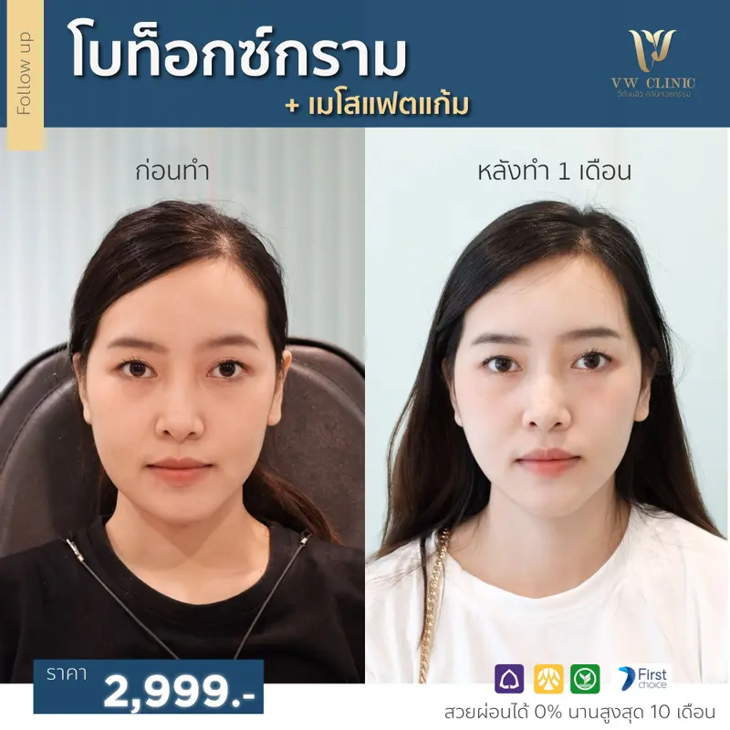 Botox กราม + Fat แก้ม