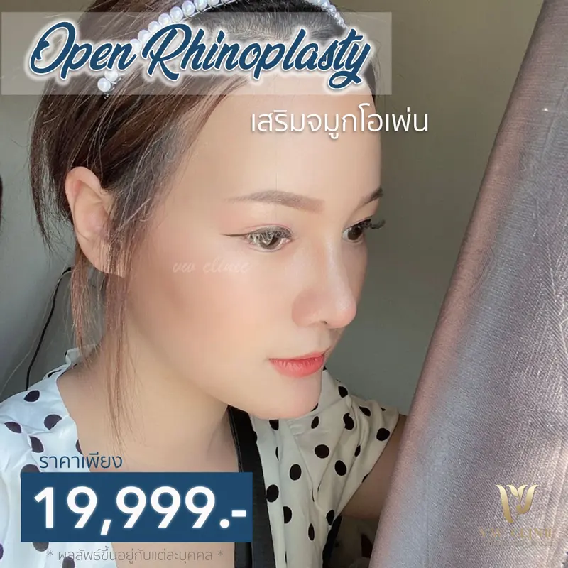 เสริมจมูก