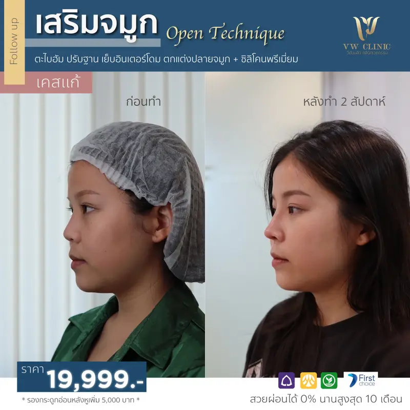 เสริมจมูก