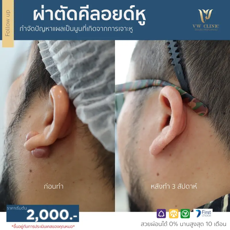 ผ่าตัดคีลอยด์หู