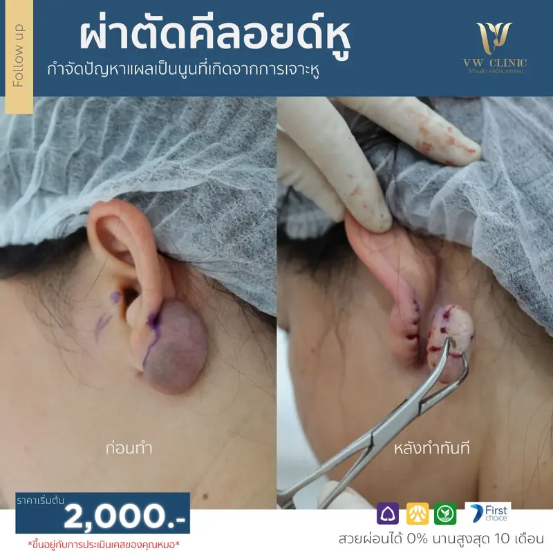 ผ่าตัดคีลอยด์หู