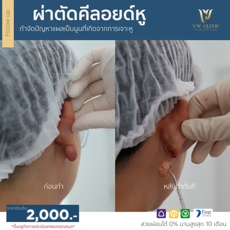 ผ่าตัดคีลอยด์หู