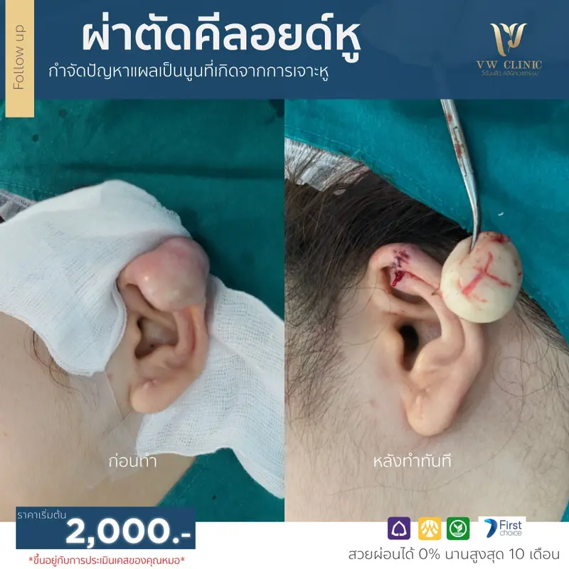 ผ่าตัดคีลอยด์หู
