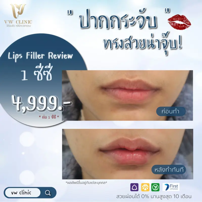 Filler ปาก