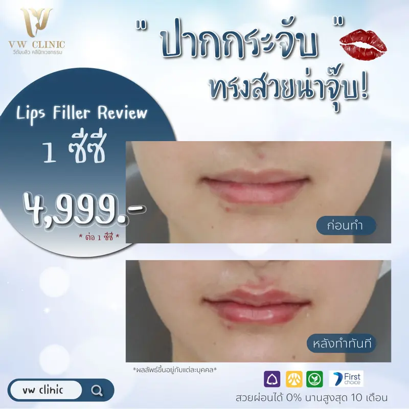Filler ปาก
