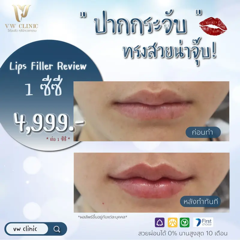 Filler ปาก
