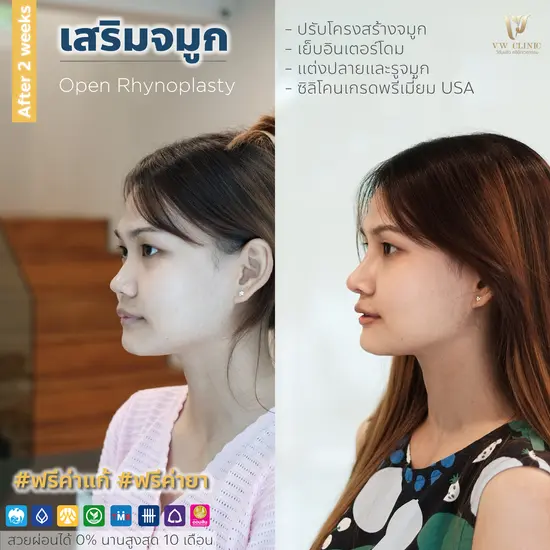 เสริมจมูก เทคนิค Open เสริมจมูก เทคนิค Open