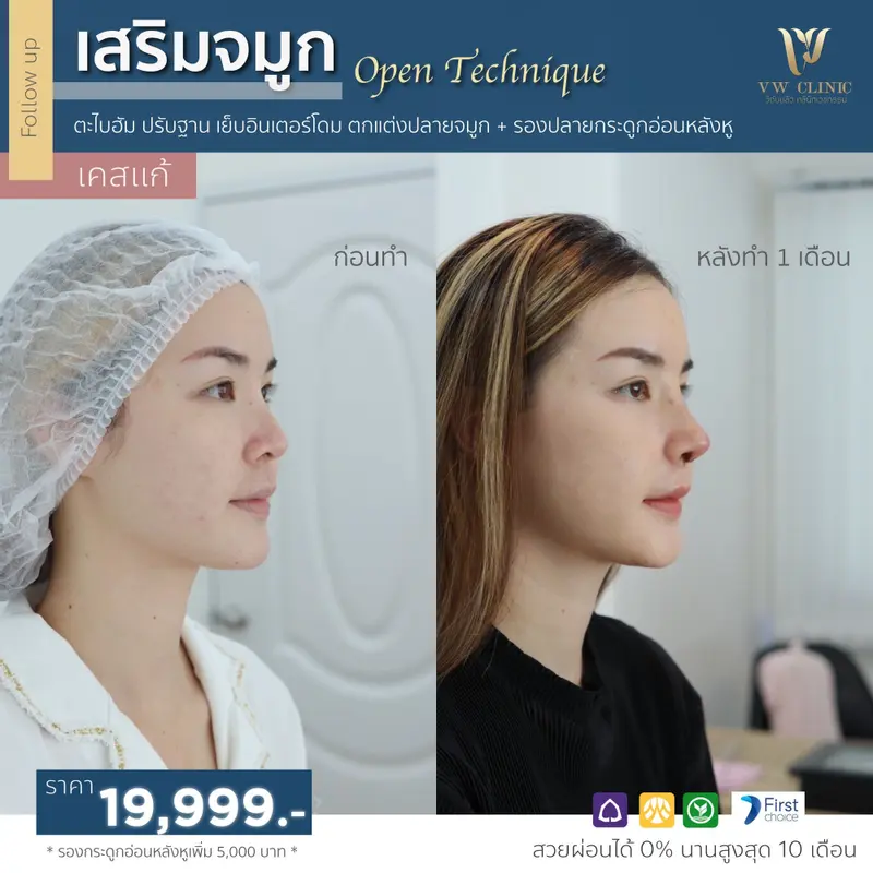 เสริมจมูก