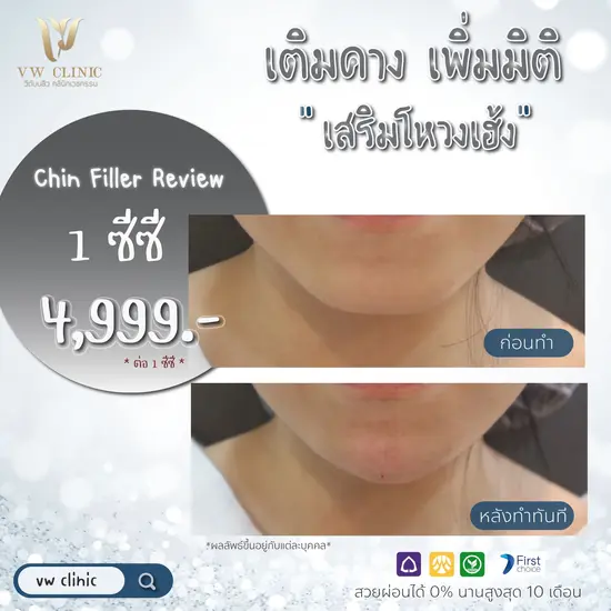 Chin Filler ฟิลเลอร์คาง