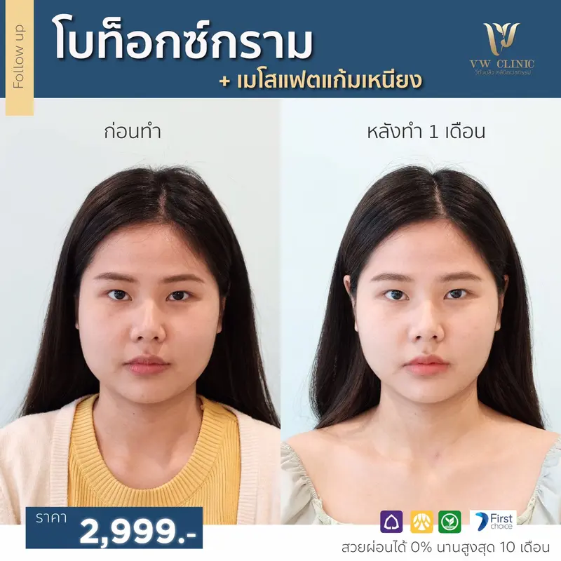 Botox กราม + Fat แก้มเหนียง