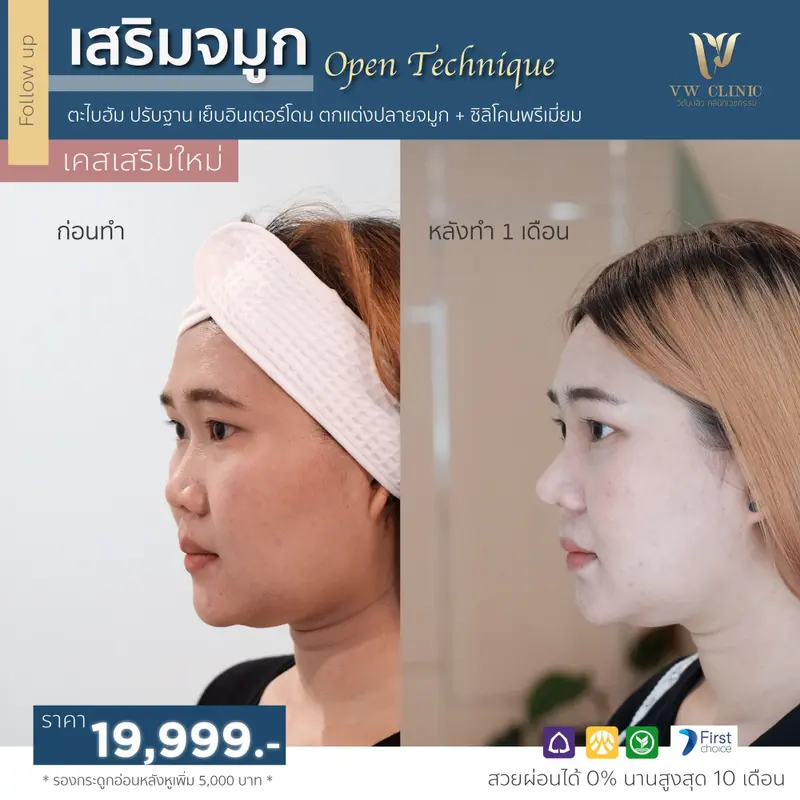 เสริมจมูก