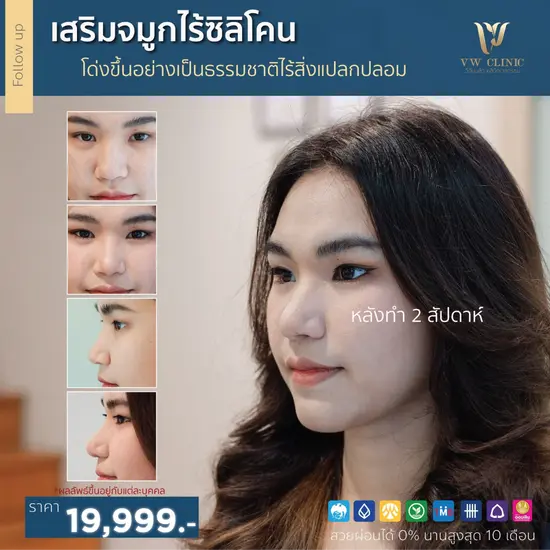 เสริมจมูกแบบไม่ใส่ซิลิโคน