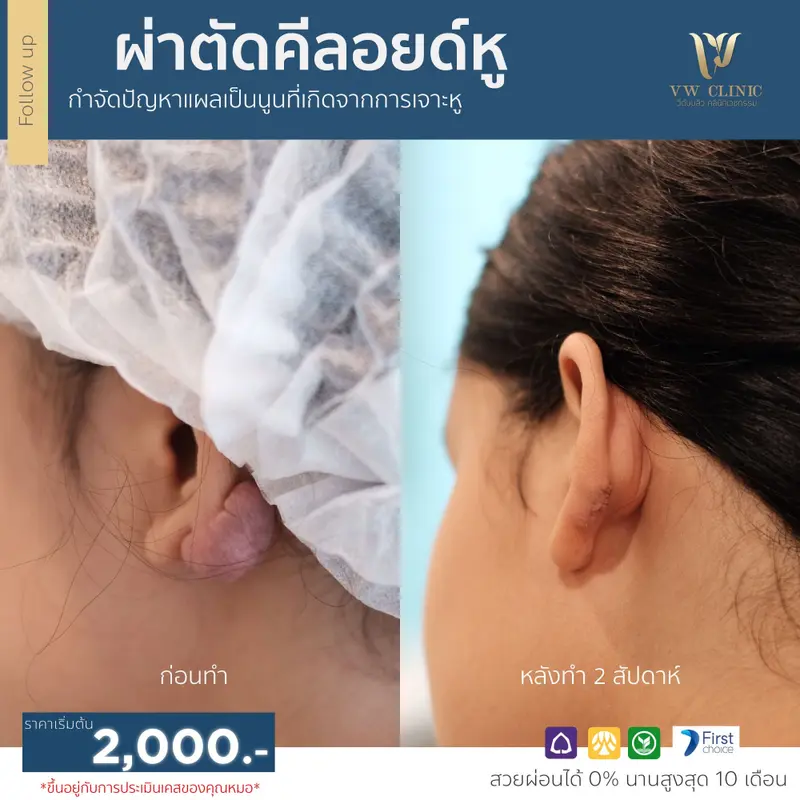 ผ่าตัดคีลอยด์หู
