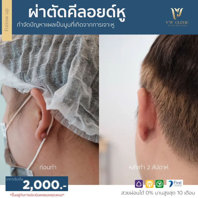 ผ่าตัดคีลอยด์หู