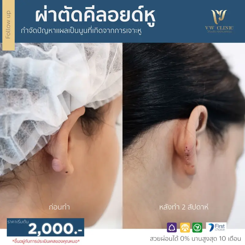 ผ่าตัดคีลอยด์หู