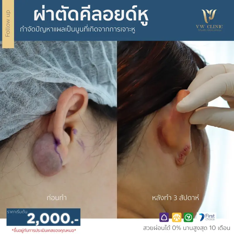 ผ่าตัดคีลอยด์หู