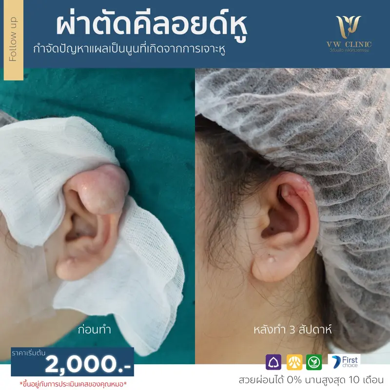 ผ่าตัดคีลอยด์หู