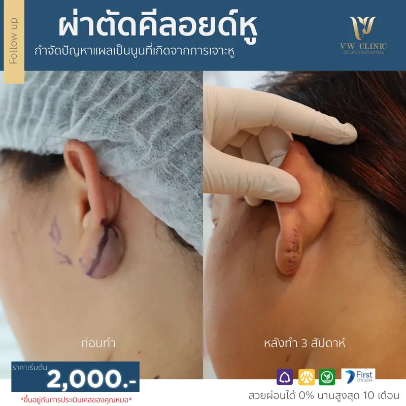 ผ่าตัดคีลอยด์หู