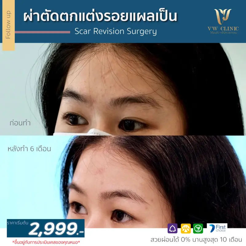 ผ่าตัดรอยแผลเป็น