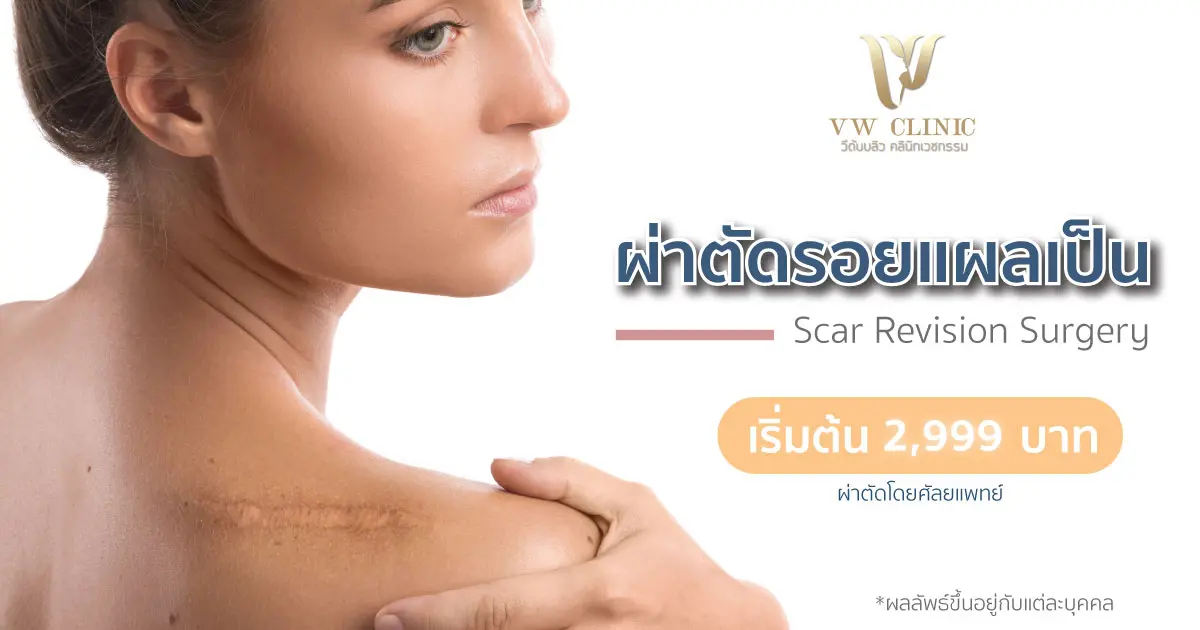 ผ่าตัดตกแต่งรอยแผลเป็น