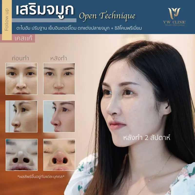 เสริมจมูก