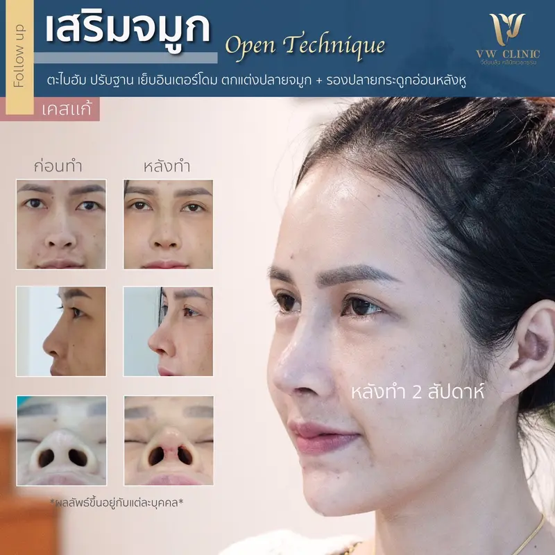 เสริมจมูก