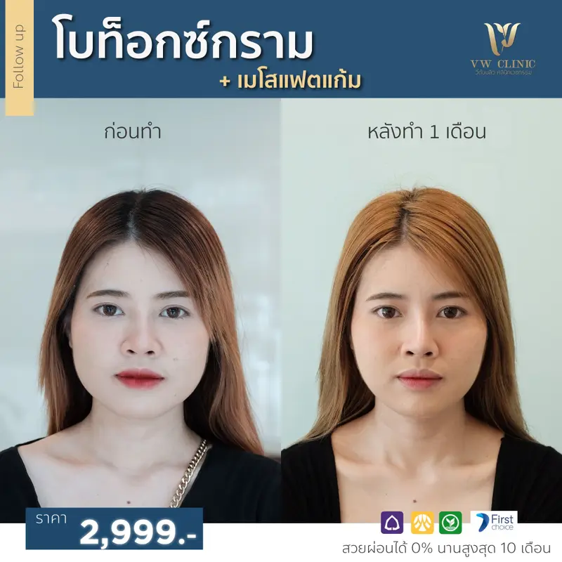 Botox กราม