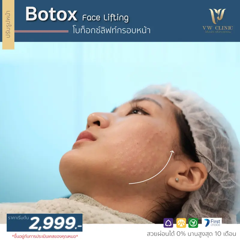 Botox lift กรอบหน้า