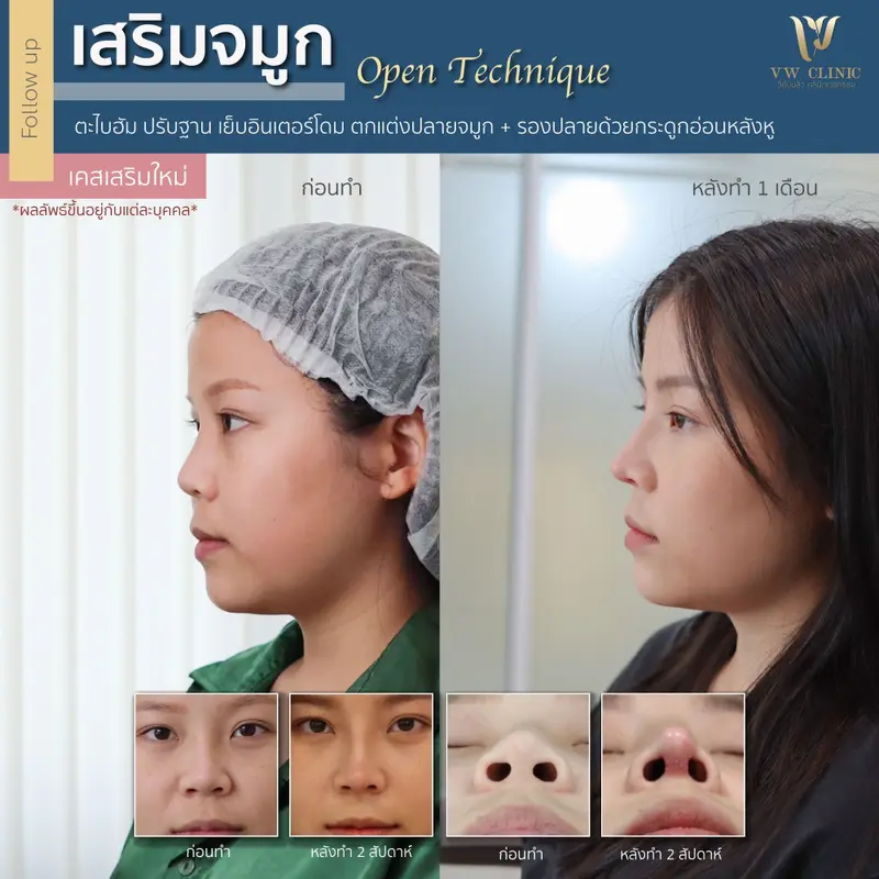 เสริมจมูก