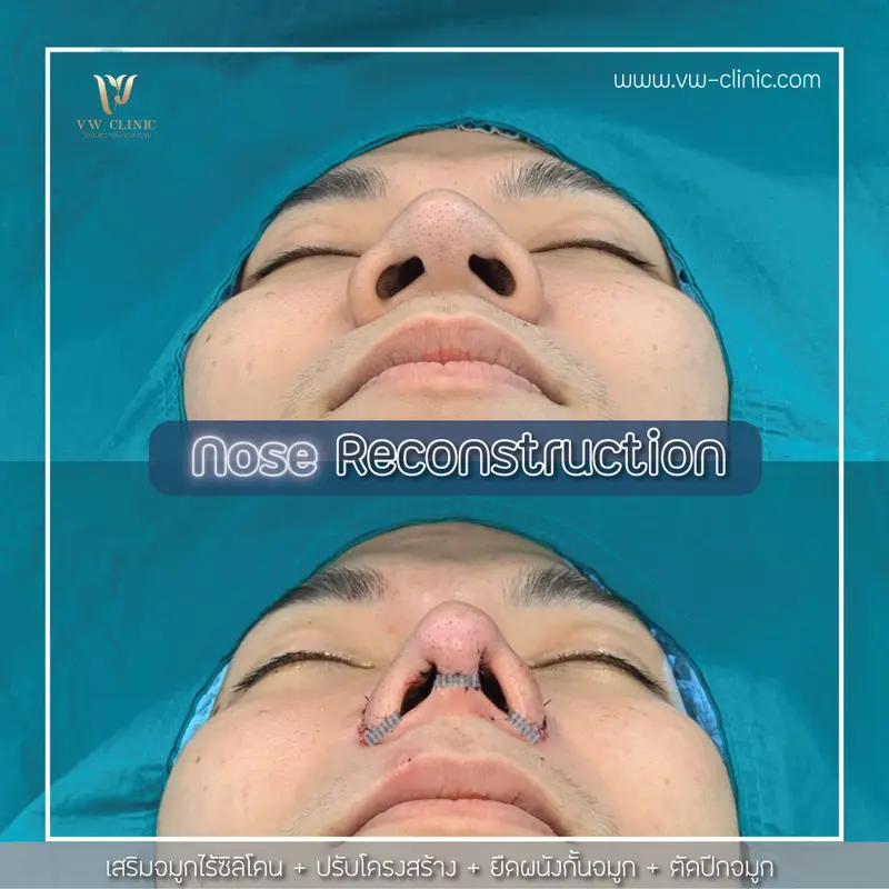 เสริมจมูกไร้ซิลิโคน