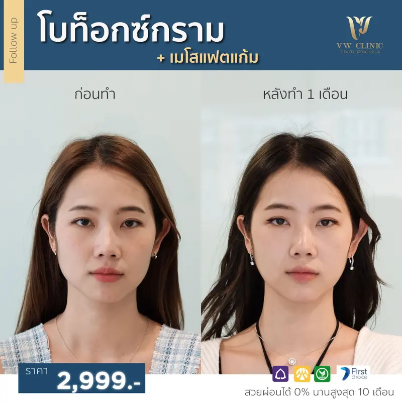 Botox กราม