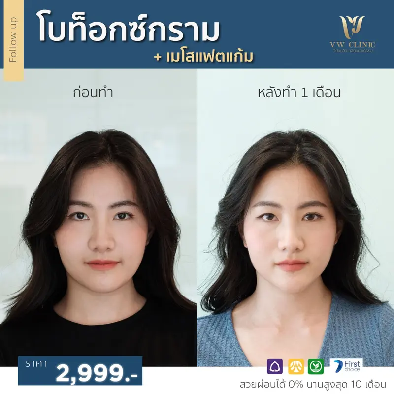 Botox กราม