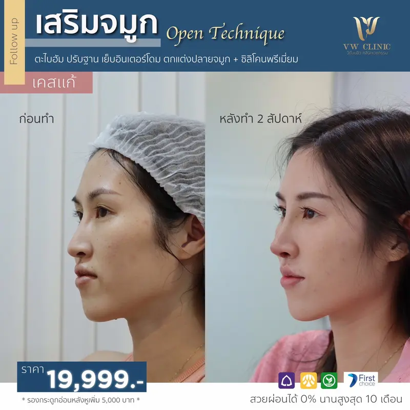 เสริมจมูก