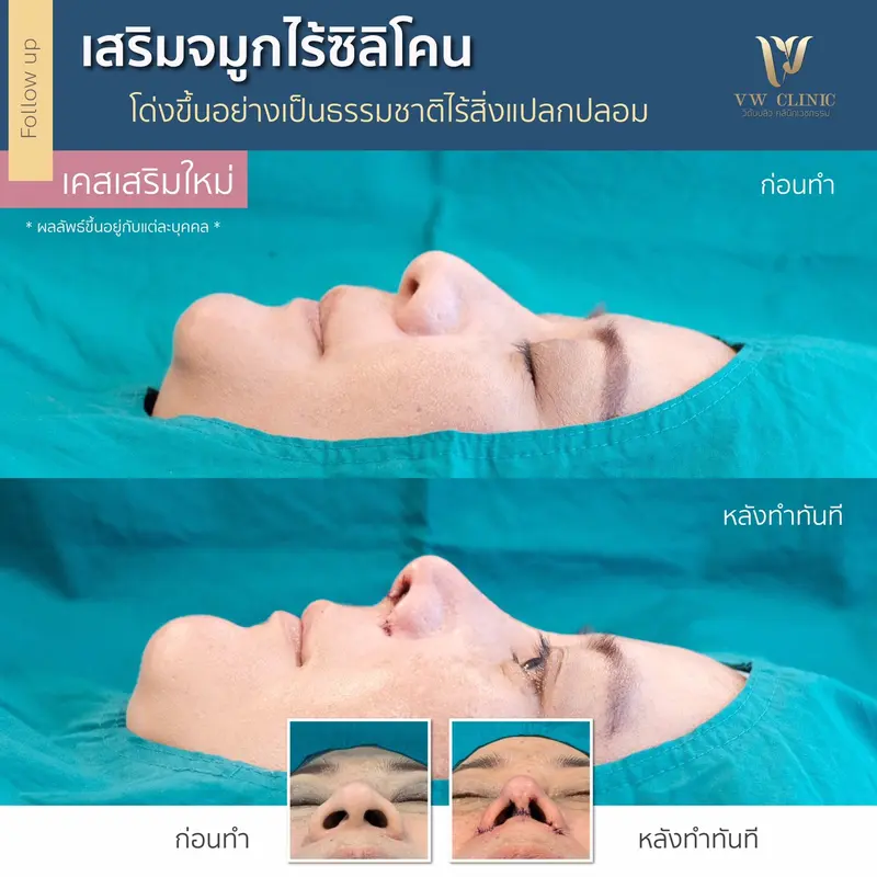 เสริมจมูกไร้ซิลิโคน