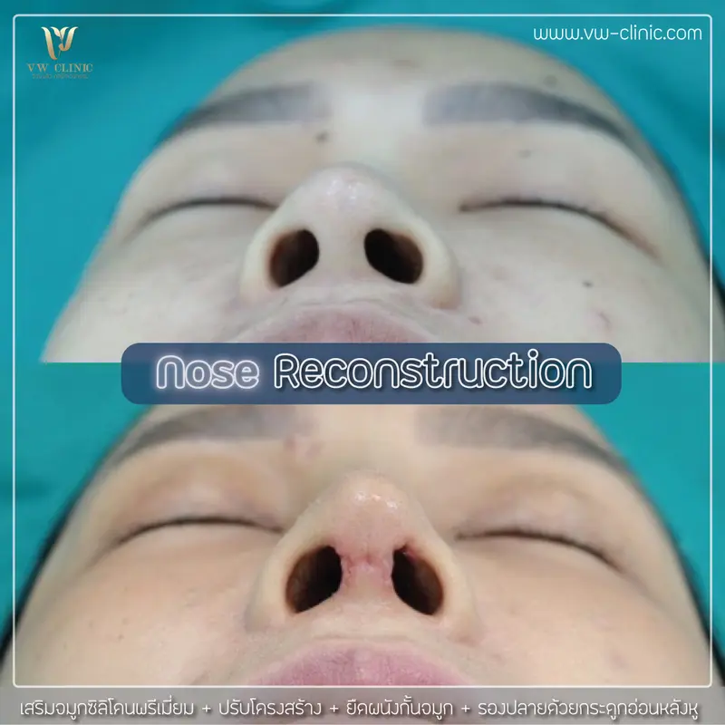 เสริมจมูก