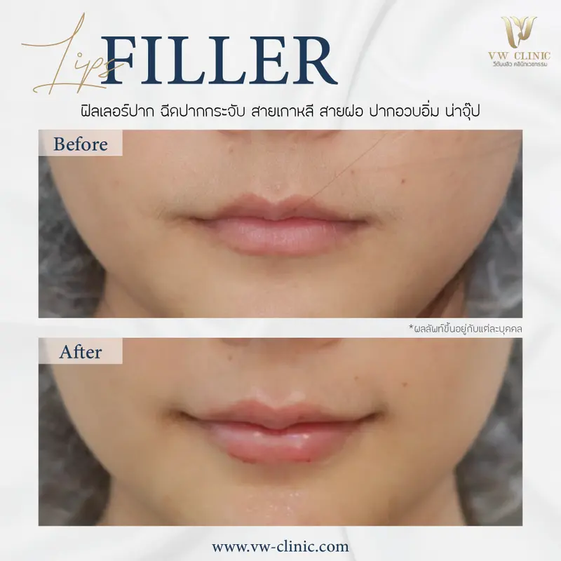 Filler ปาก