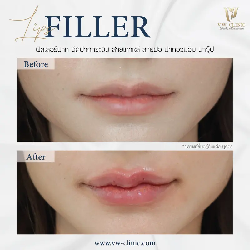Filler ปาก