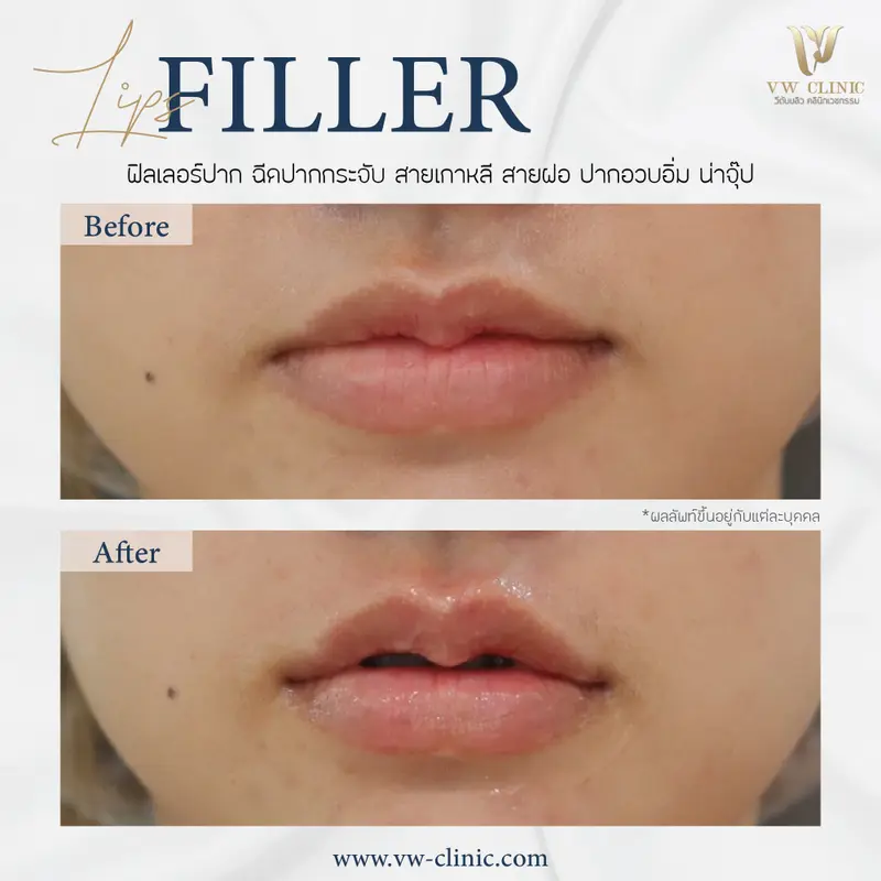 Filler ปาก