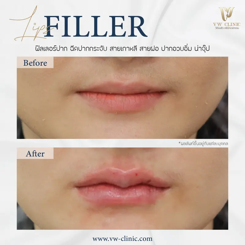 Filler ปาก