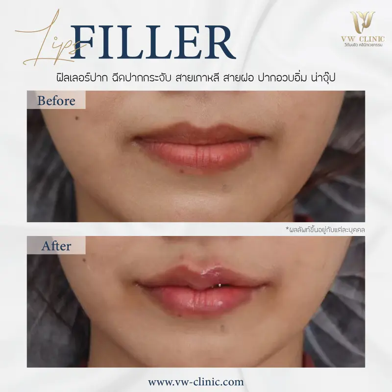 Filler ปาก